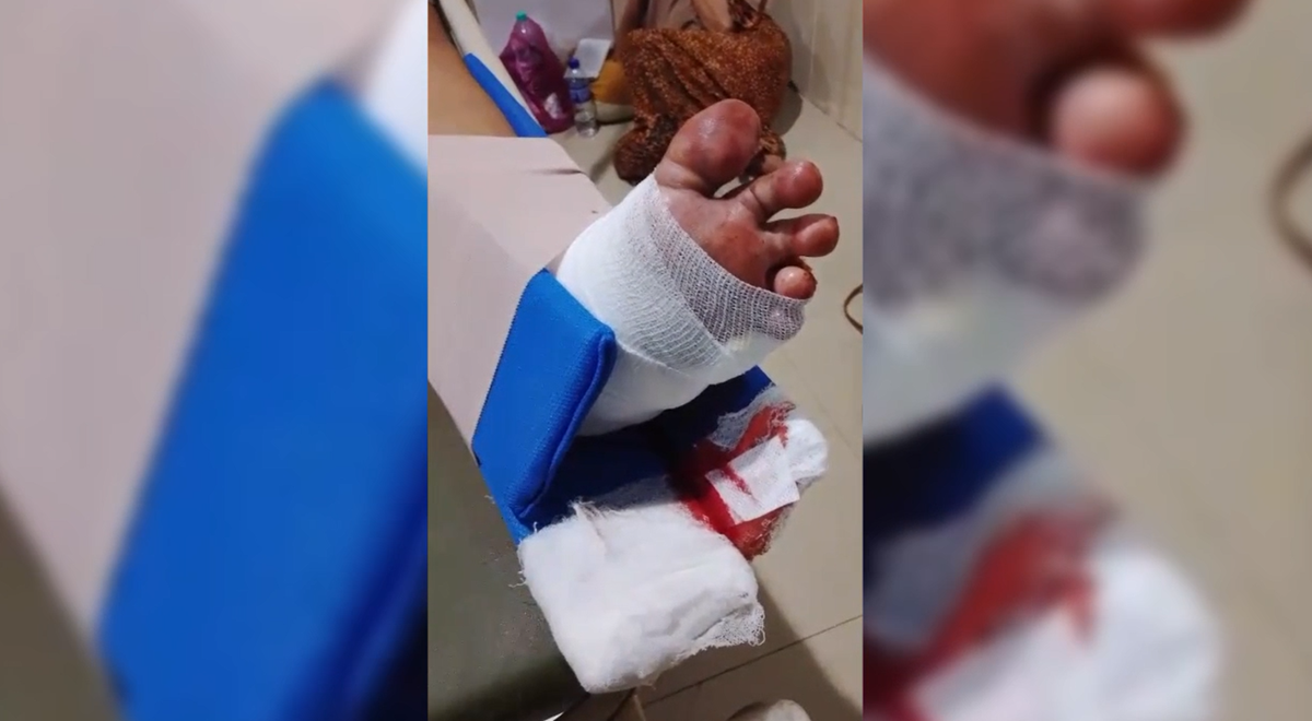 Anak SD Jadi Korban Begal, Kaki Remuk Dan Motor diambil