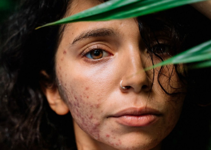 Solusi Jerawat Meradang Terpercaya, B Erl Very Berry Acne Spot treatment Bisa Beli Disini !!!